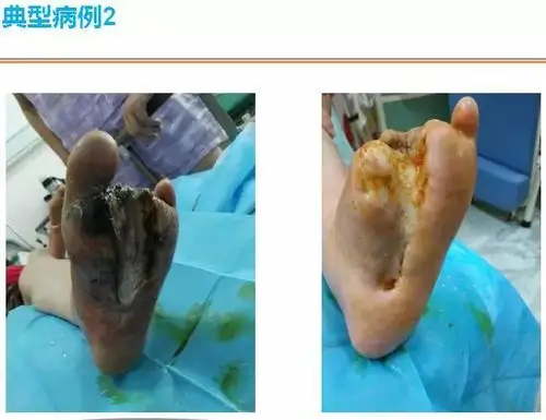 喜讯截肢伤口不愈合糖尿病足的救星济宁市中医院蛸红敛疮油获批成功