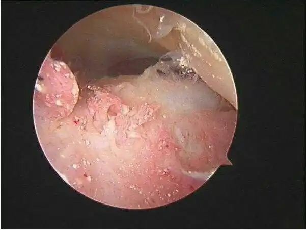 尿酸钠盐结晶对膝关节的影响