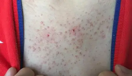 艾滋病胸前长红点图片艾滋病初期4个异常藏不住