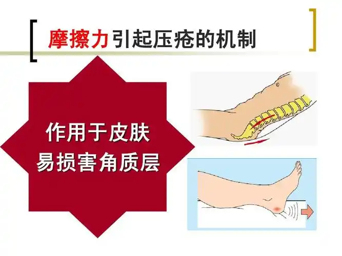 压疮风险评估ppt