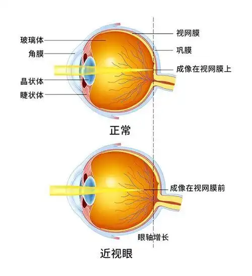 科视眼科注意这几点让孩子远离屈光不正
