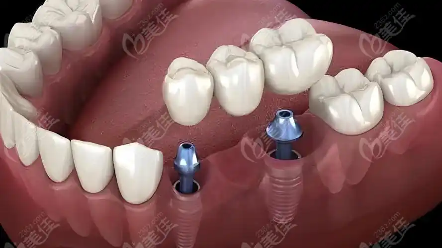 深圳爱康美口腔价格表:种植牙价格2300起|金属矫正6000起|牙齿贴面