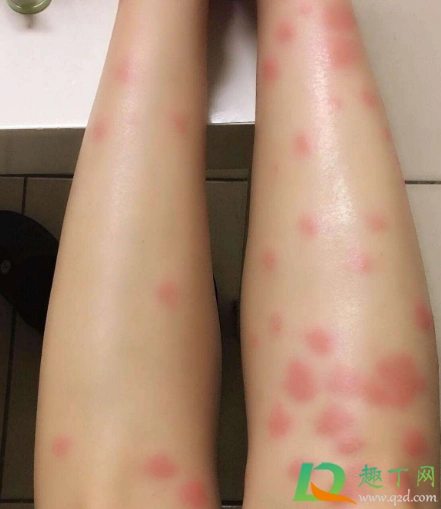 跳蚤咬过后的疙瘩照片跳蚤咬后是什么样子的