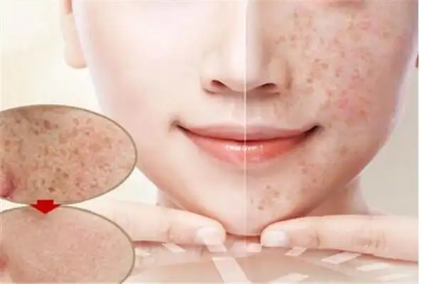 曲洪欣祛斑祛痘祛加盟电话