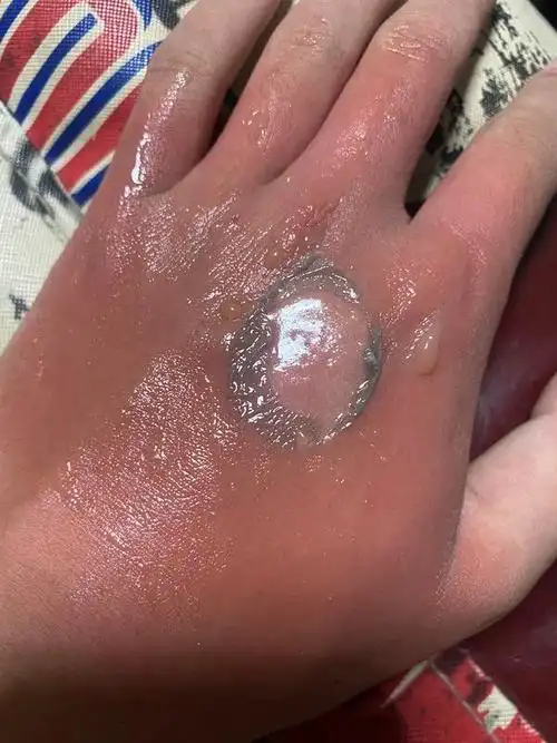 数分钟后可以消肿止痛烫伤的治疗十一烫伤后, 马上抹些肥皂