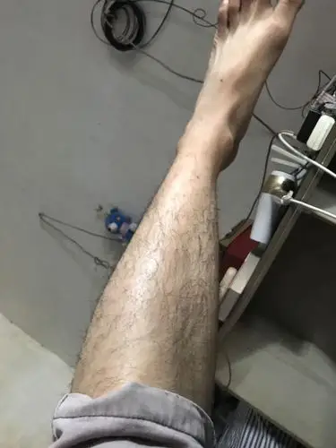 现在腿毛好长了.短裤都不敢穿了 怎么办啊