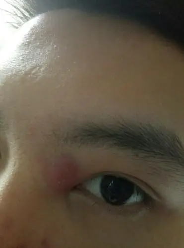 眼睛旁边长了个囊肿大痘都十天了摸起来软了就是不见白头想挤都挤不了