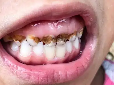 牙齿腐烂计划图片