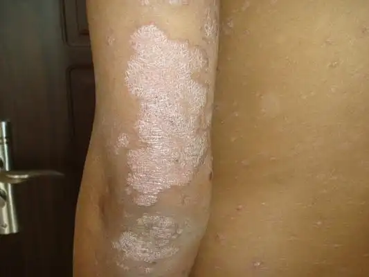 体癣初期图片 (49)