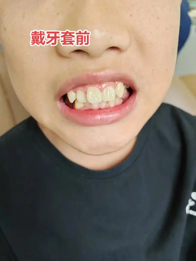 牙齿矫正 #带牙套牙套的日子  戴牙套40天的变化过程 - 抖音