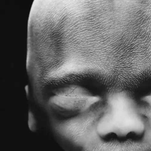 胎儿子宫内发育震撼照:10周大胎儿眼睑半闭