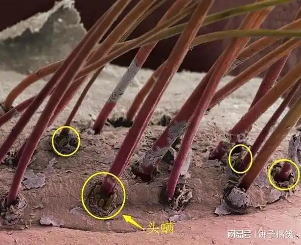 头发上抠下来的白色脏东西,究竟是什么?显微镜下看到它的真面目