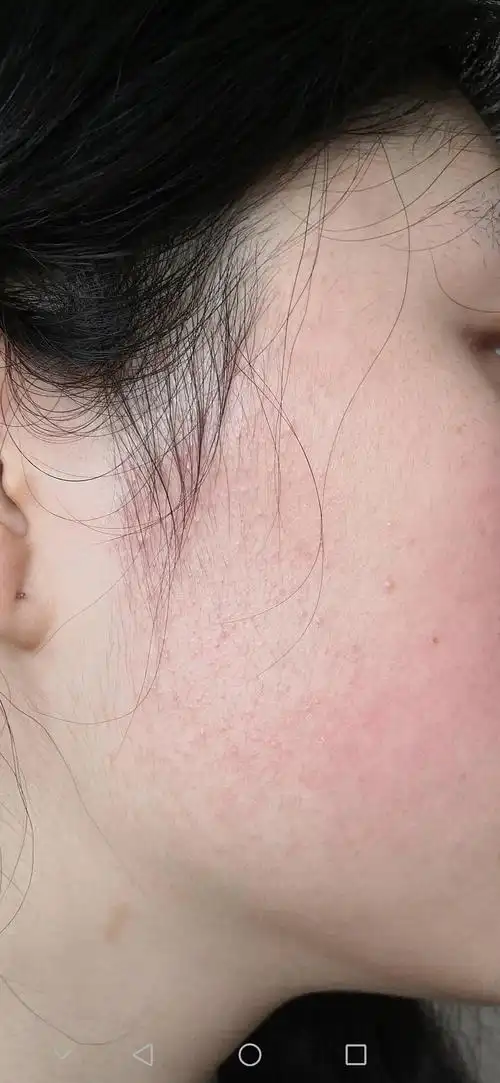 求助我是皮肤屏障受损了吗慎入