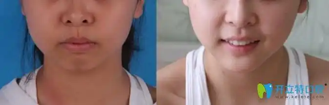 解答上牙包住下牙多少正常