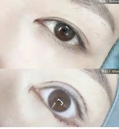 眼睑下至刚做完的图片