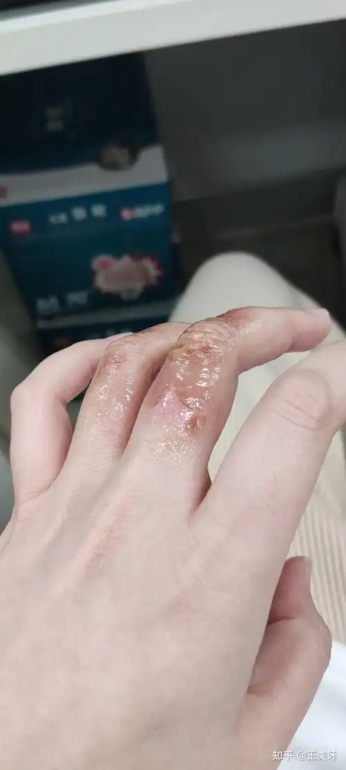 今天是两星期整了,我的还没好看来我这个烫伤比浅二度还要严重点.