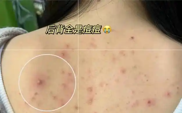 每天五分钟,在家洗出嫩白皮!|螨虫|痘痘|瘙痒|角质层|去角质_网易订阅