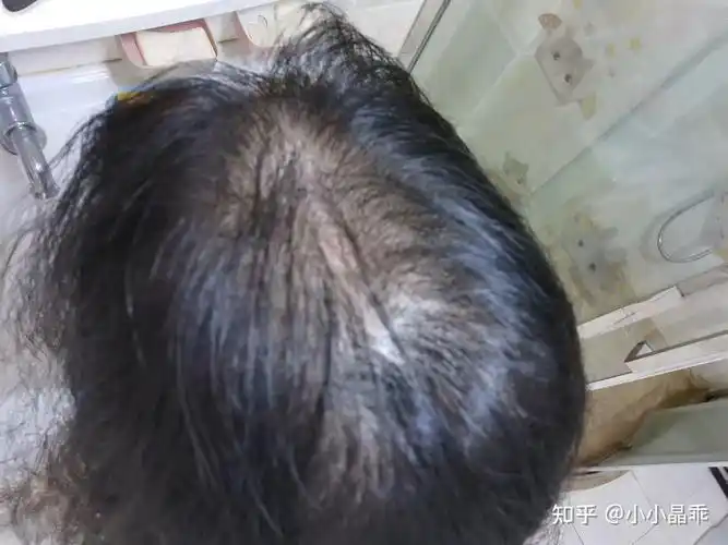 产后脱发 - 知乎