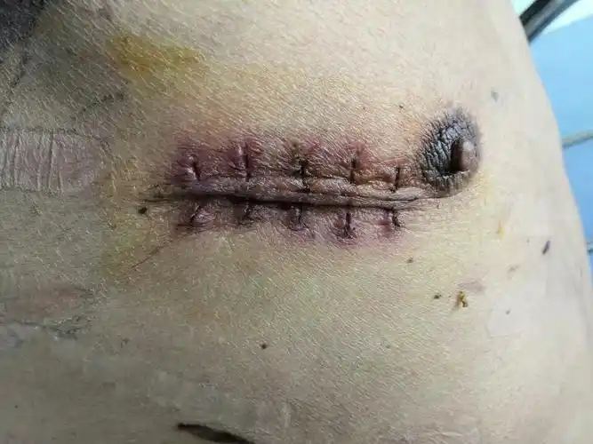 永城市人民医院胸外科手术分享