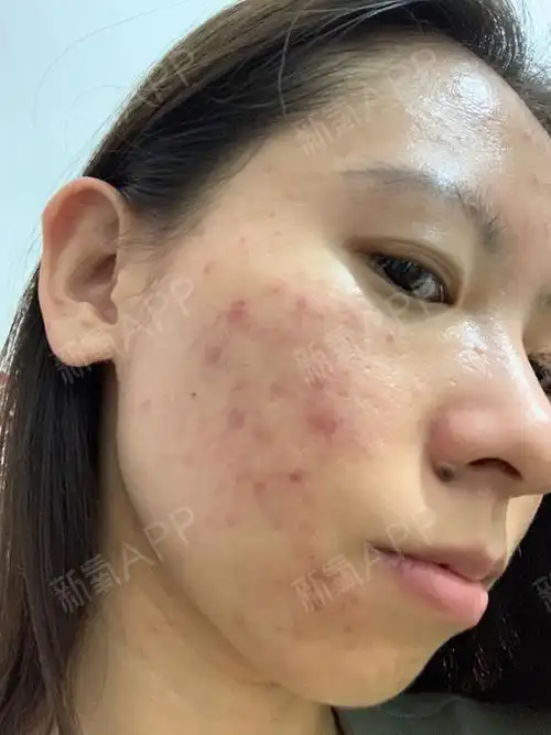 果酸换肤第四次的第二天脸干结痂了疼难看.