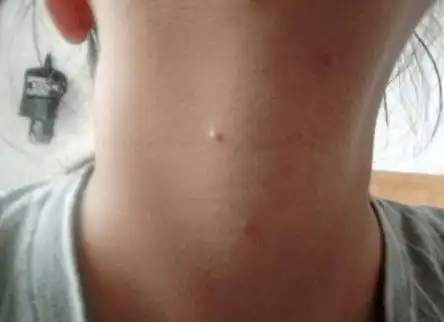 脖子莫名长出几颗小肉粒,这是怎么回事?这些小肉粒是啥?_手机搜狐网