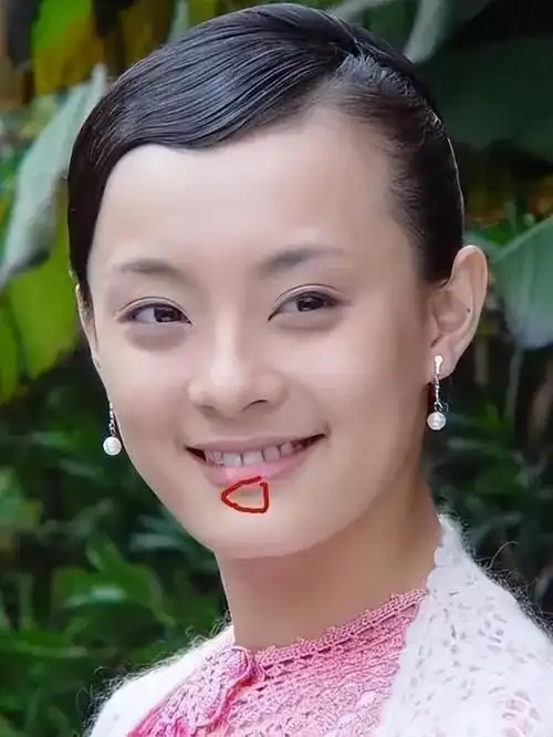 孙俪突然变美眼睛不凸也不发腮了,下巴的痣引热议!被质疑整容