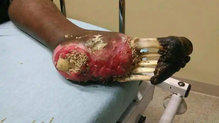 败血症图片 (84)