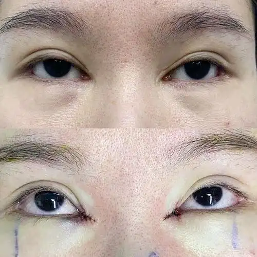 刚做的内眼角回包,局麻做的,全程不疼的,麻药过后,_圈子-新氧美容整形