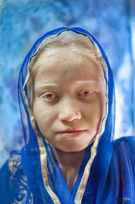 打破歧视摄影师花两年拍摄让世界看见白化症的美