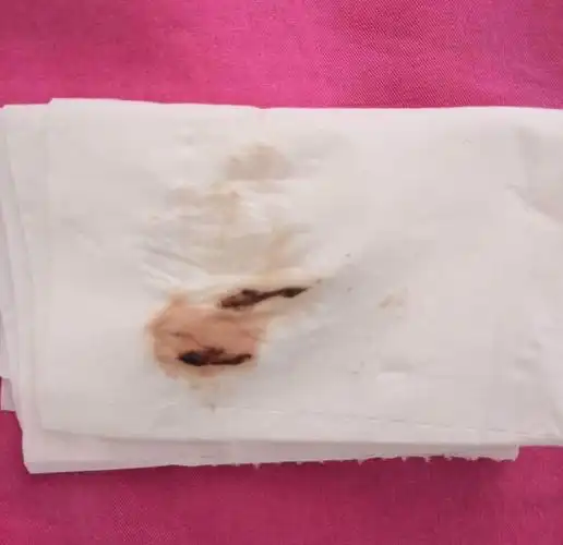 首先,我们要知道移植后出血或怀孕早期出血是很常见的,大概20-30%的