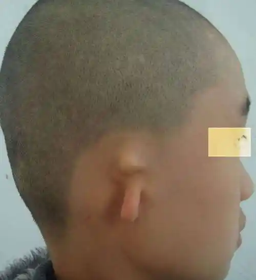 小耳畸形