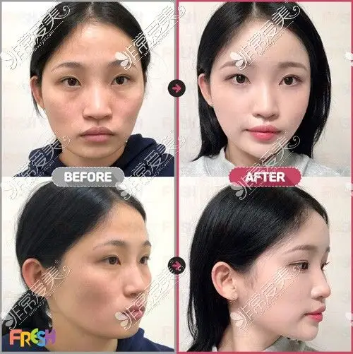 全脸脂肪填充前后对比