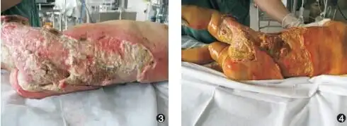 多种药物联合肌注引起大面积皮肤坏死