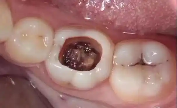 牙齿变黑之后不疼就不用管吗?蛀牙对身体影响大吗?看完长知识了