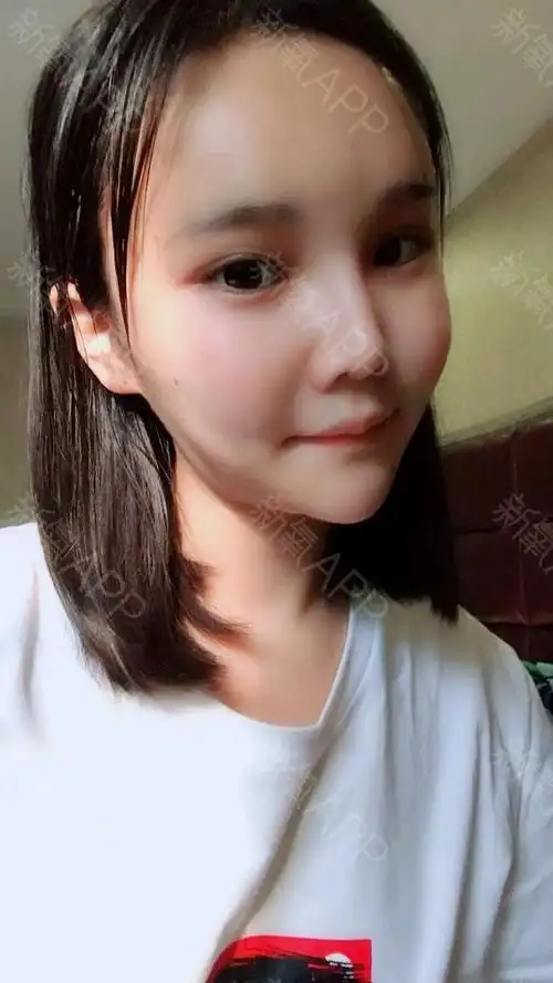 重庆自体脂肪全脸填充好不好_效果图_兮兮hoo自体脂肪全脸填充术后第3