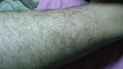 腿上的毛孔发红而且有点凸起,就想图上一样,这事怎么回事,该怎么办呢?