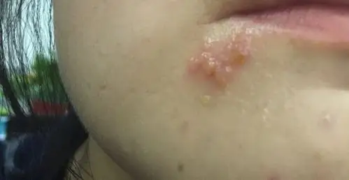 自己按照经验涂了红霉素软膏,但是没什么用.这种小水