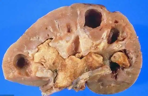 如何通过药物控制尿酸性肾结石?-陈波-爱问医生