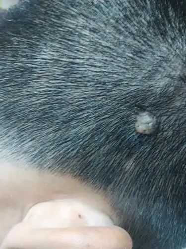 我的头皮上有个小的肉瘤,怎么办?