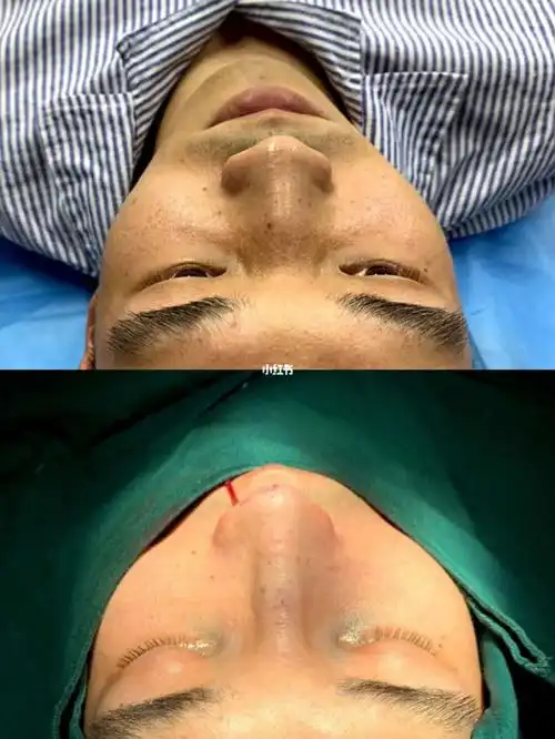 驼峰鼻矫正 肋骨鼻 鼻综合整形_鼻综合_整容_肋骨鼻_上海自由行热门