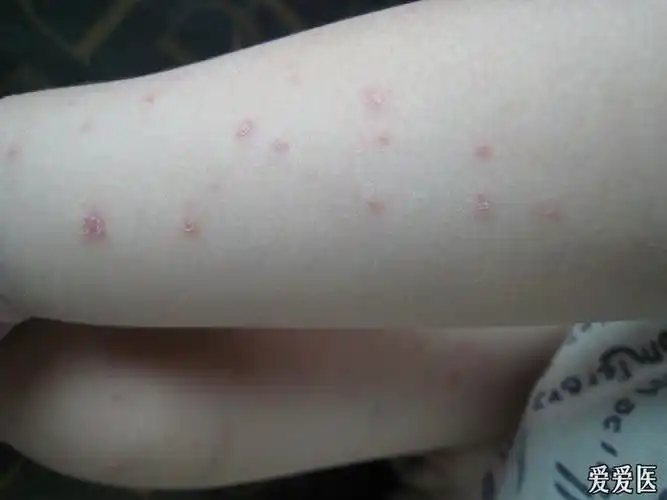 螨虫皮炎治疗前后您来看一看