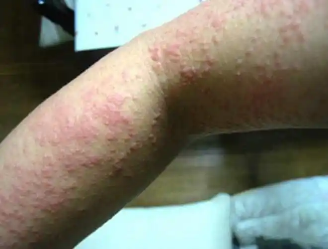 大人湿疹症状图片_有来医生