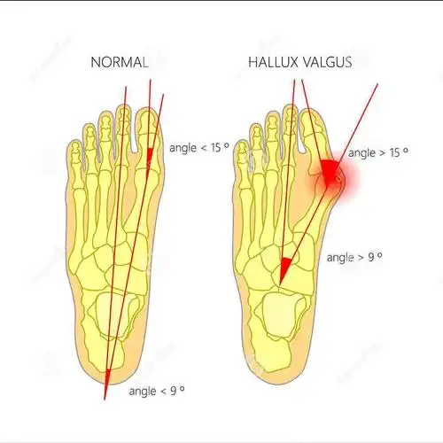 大脚骨的疼痛要如何缓解,大脚骨医生和你讲一讲,看清楚