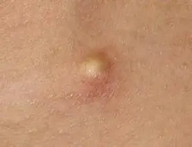 身上长了粉刺瘤,皮脂腺囊肿怎么办