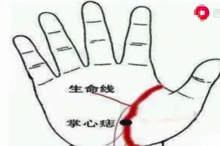 手掌上痣位置与命运(手掌上痣位置与命运图)