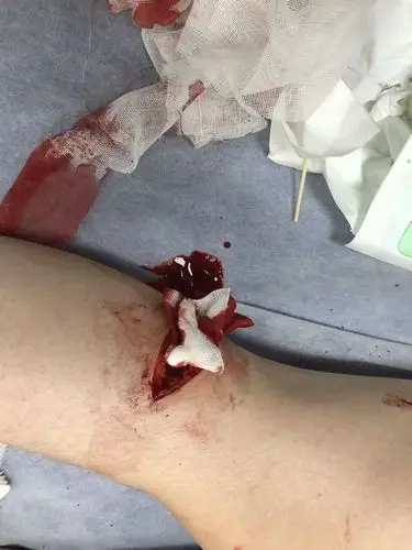 近三年的男友,因为吵架动手打我,还持刀把我砍伤.