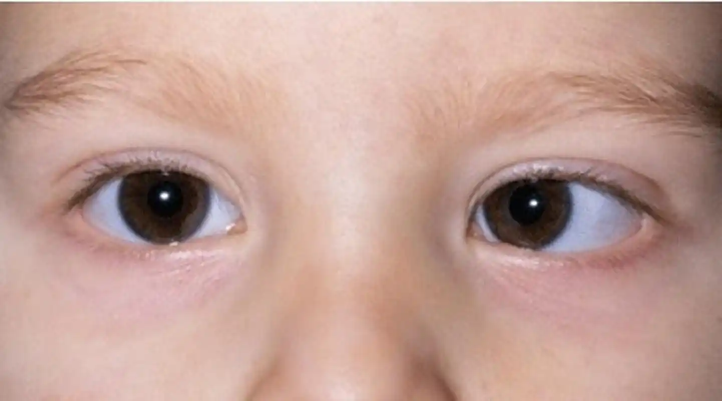 先天性斜视是一种儿童眼疾,通常在婴儿期或幼儿期就会出现.