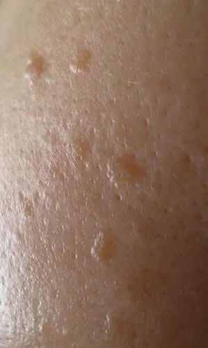 脸上长了些小疙瘩,,有点像斑,但不是斑那种平平的,有点凸凸的,摸上去