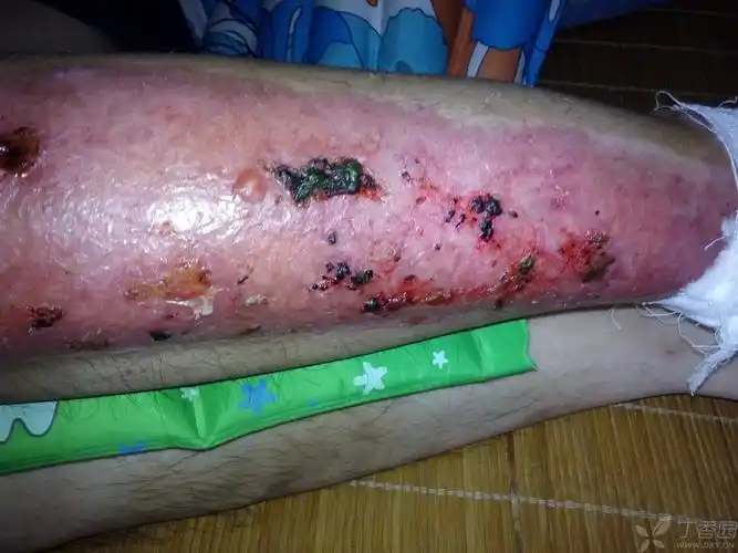 【求助】取皮出伤口流水后结痂为什么有什么好方法处理