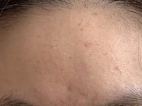 求助干皮夏天额头出油毛孔粗大怎么整